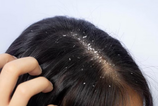 Can Scalp Treatment Remove Dandruff?